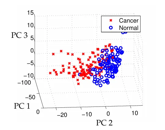Clustering of samples that are normal and those that have cancer in the first three principle component coordinates.
